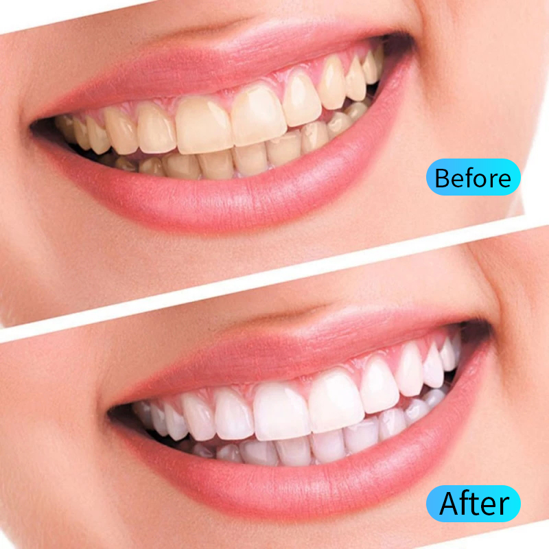 Teeth Whitening Gel Kit Oral H - Teeth Whitening Opalescence 评论和价格