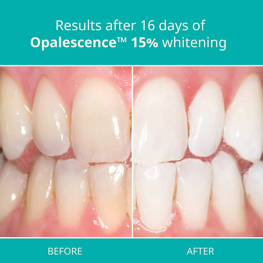 Opalescence Professional White - Teeth Whitening Opalescence 评论和价格