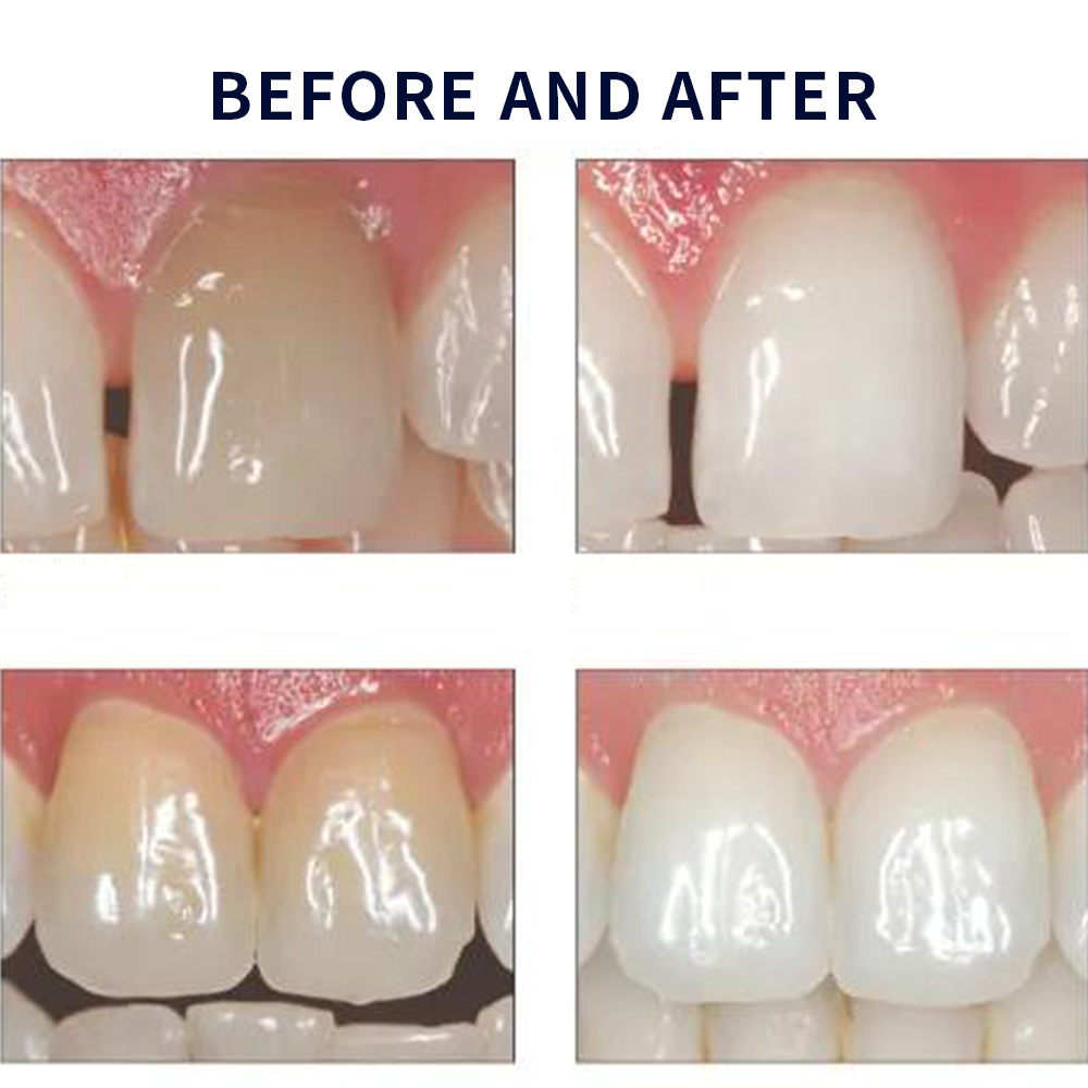 Opalescence Whitening 20% PF 2 - Teeth Whitening Opalescence 评论和价格