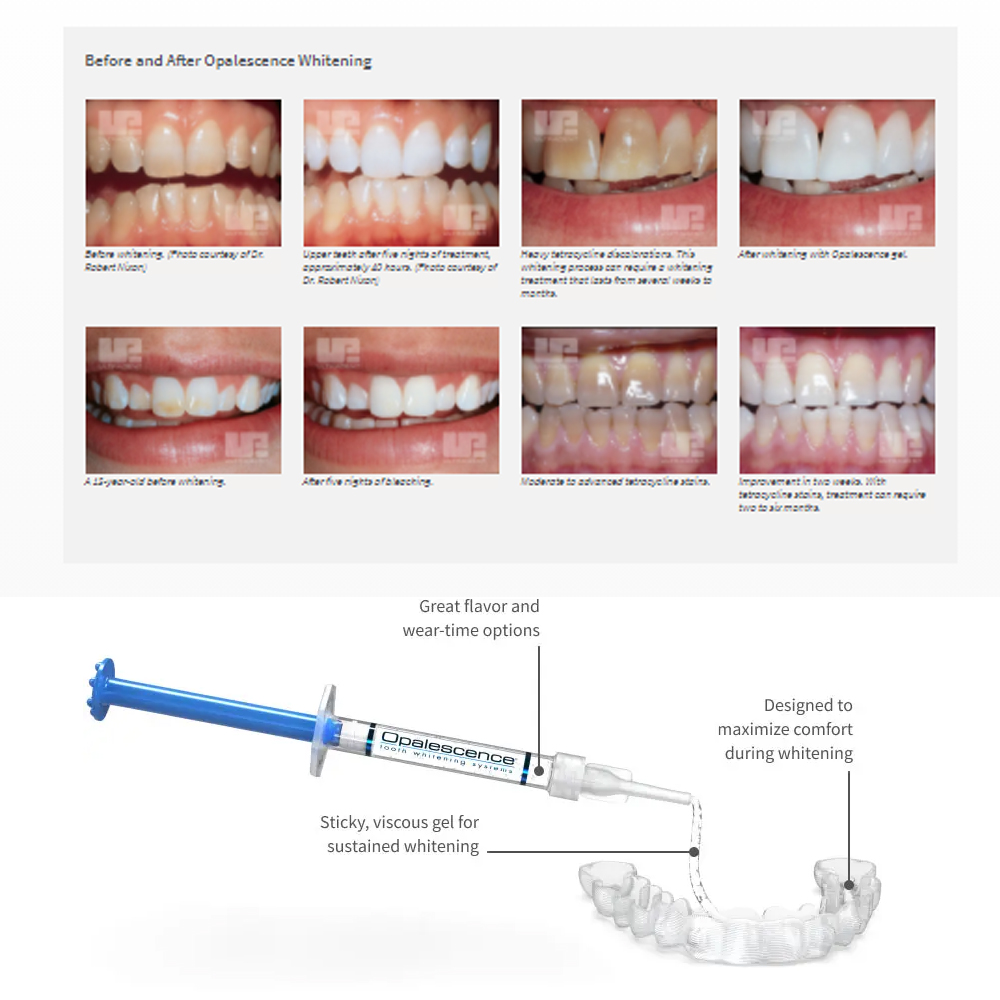 Opalescence Whitening 20% PF 2 - Teeth Whitening Opalescence 评论和价格