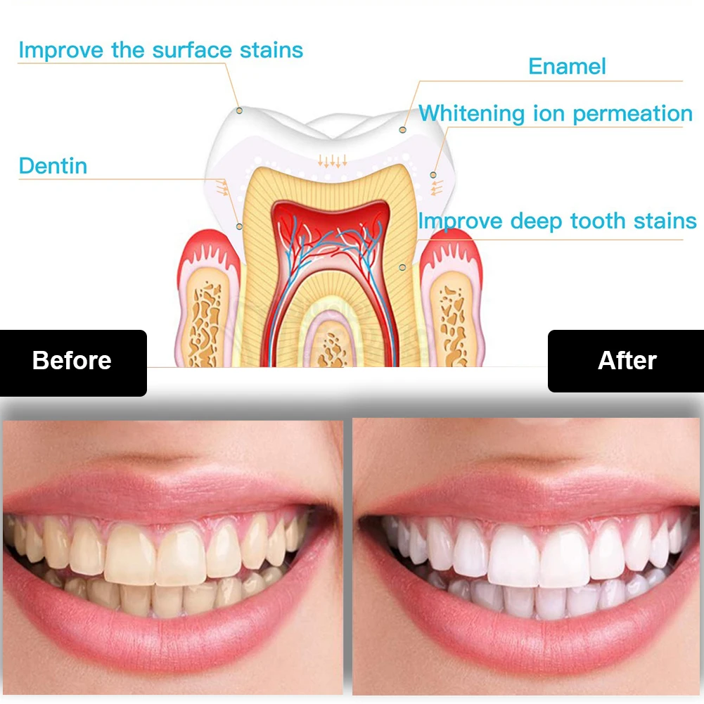 Dental Teeth Whitening Kit Min - Teeth Whitening With Blue Light 评论和价格