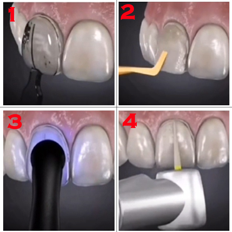 32pcs Dental Veneer Mould Kit  - Teeth Whitening Kit With Light 评论和价格